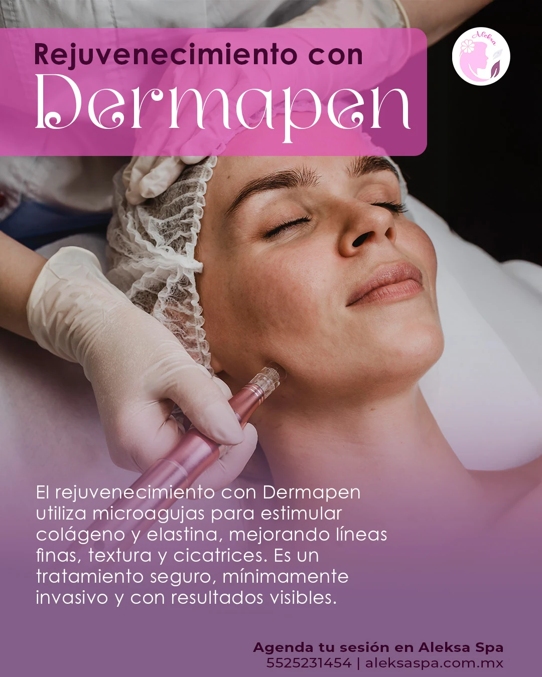 Pieza informativa de Aleksa Spa sobre rejuvenecimiento con Dermapen