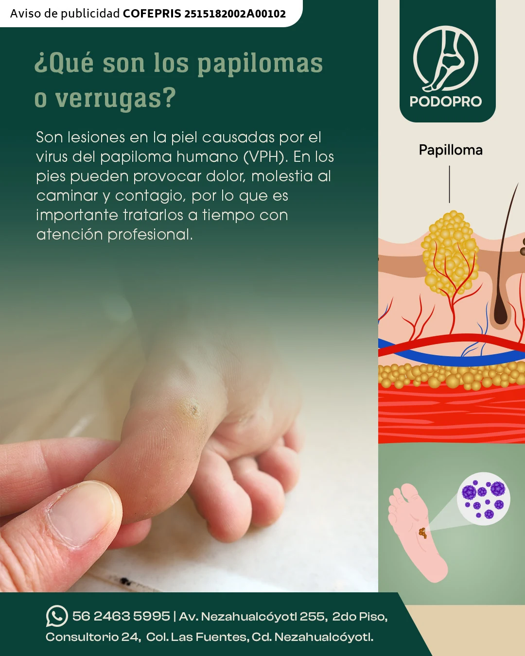 Publicación educativa de Podopro sobre papiloma plantar con representación clínica de la lesión