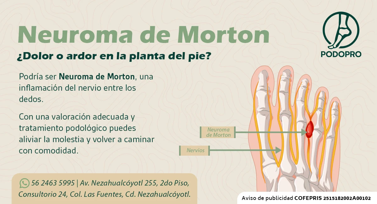Publicación de Podopro sobre neuroma de Morton con recurso anatómico para localizar la afección